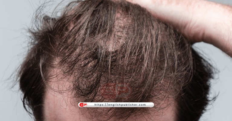 acne and hair loss